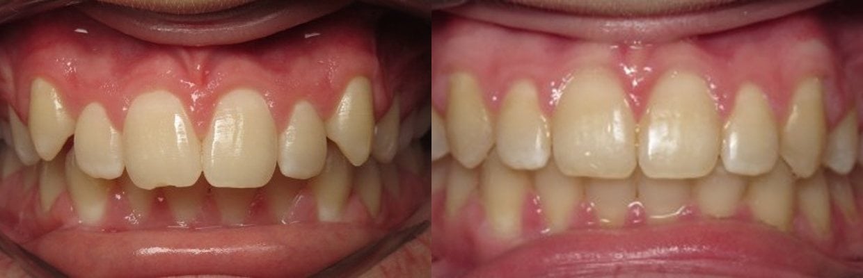 Before and After Orthodontic Treatment