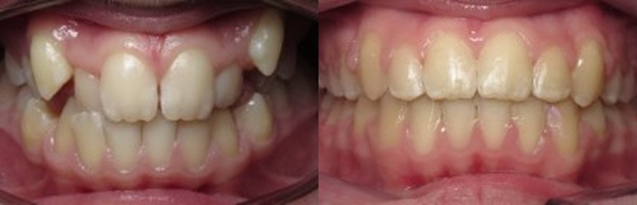 Before and After Orthodontic Treatment