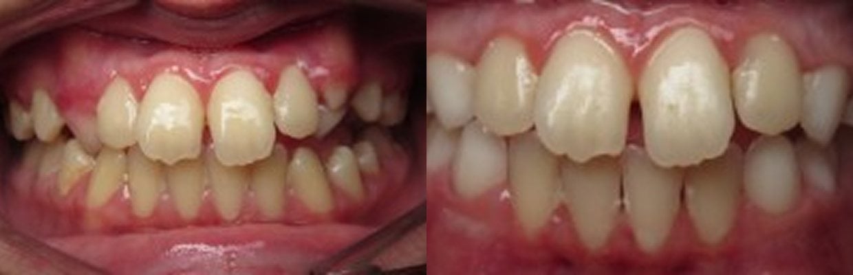 Before and After Orthodontic Treatment